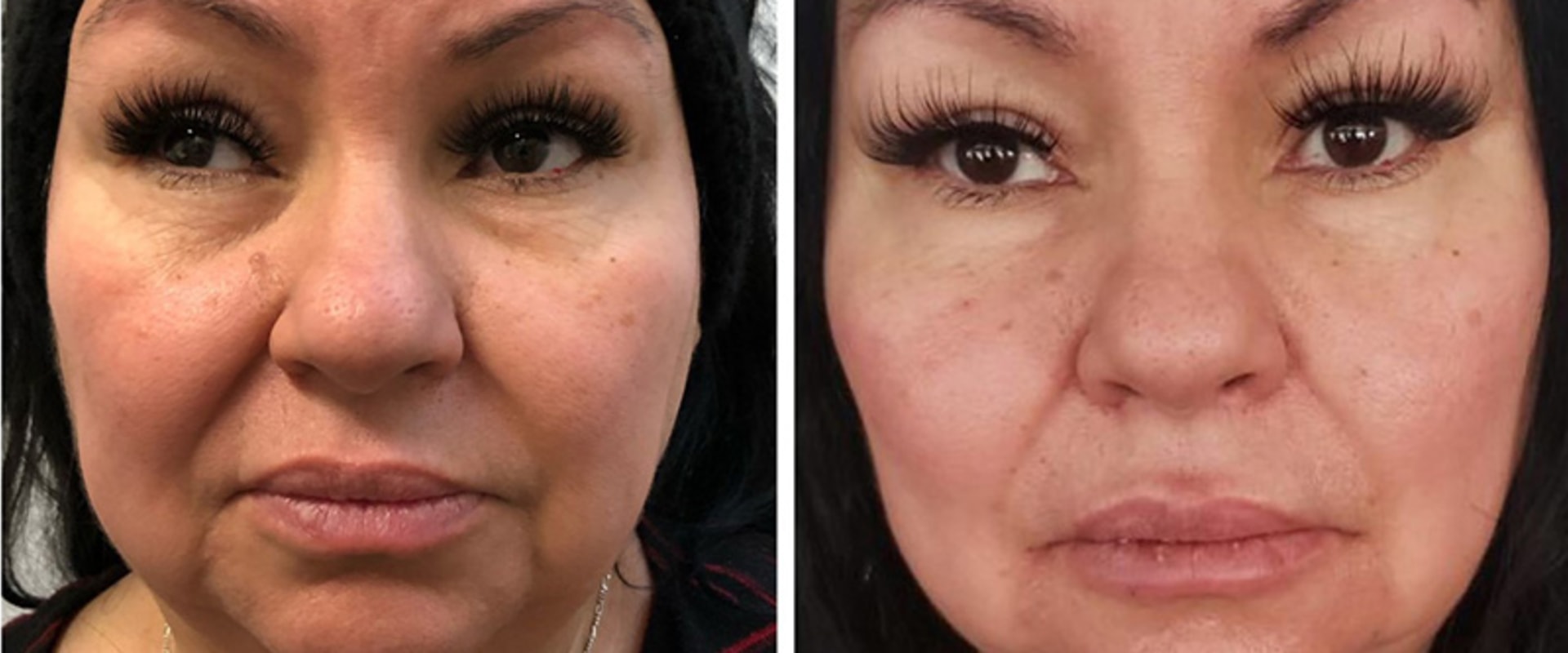 Do Fillers Look Better After They Settle?