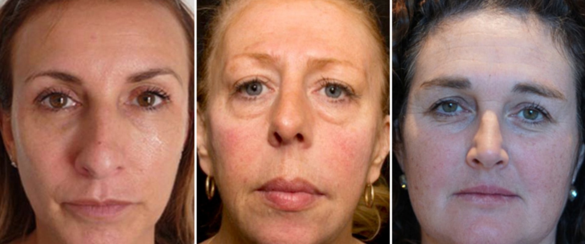 What Happens to Your Face After Years of Fillers?