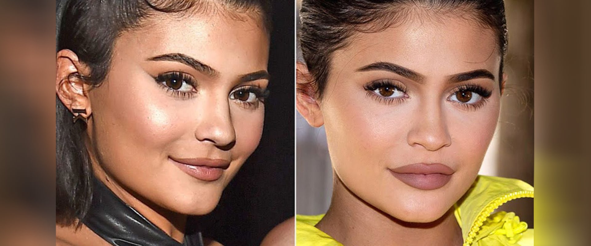 Can Filler Last Forever? Understanding the Lifespan of Lip Fillers