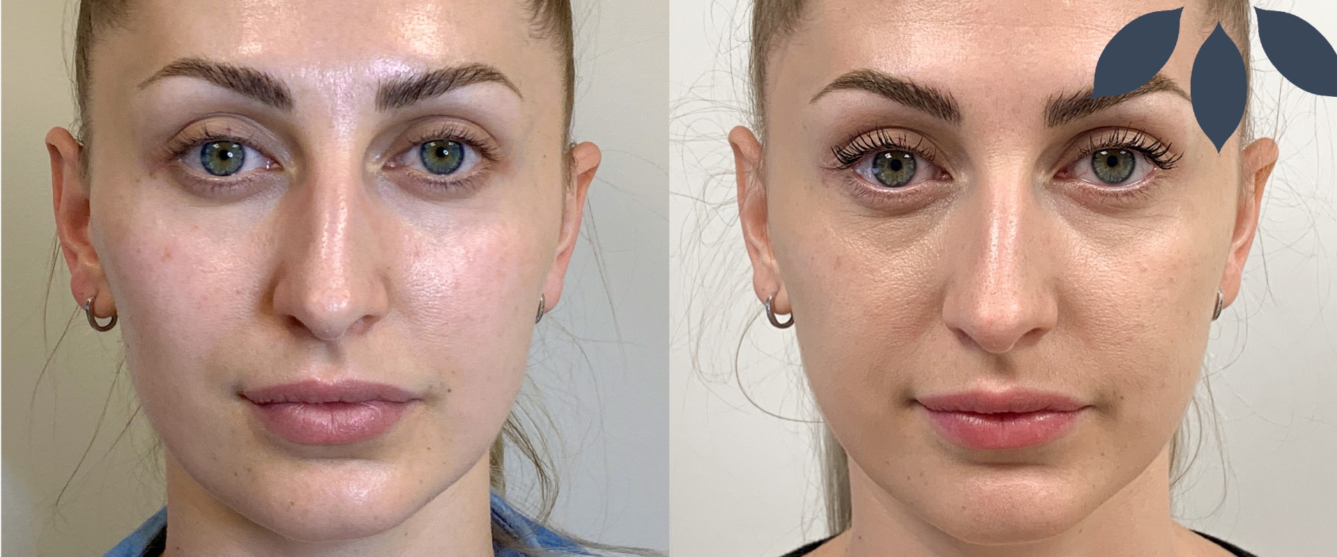 What Happens to Your Face When Fillers Wear Off?