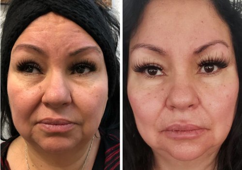 Do Fillers Look Better After They Settle?