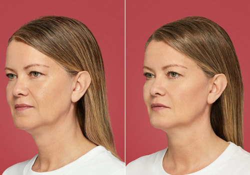 Does Facial Filler Look Better Over Time?