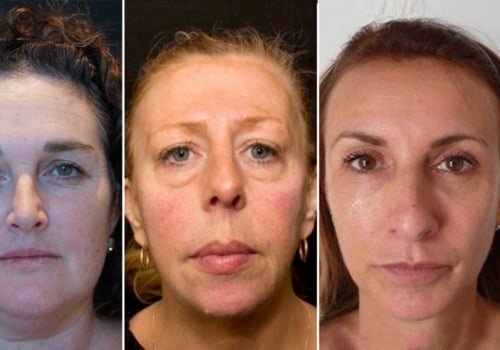 What Happens to Your Face After Years of Fillers?