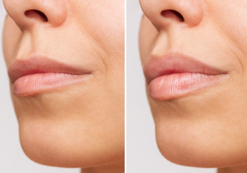 Is it normal for fillers to feel hard after?